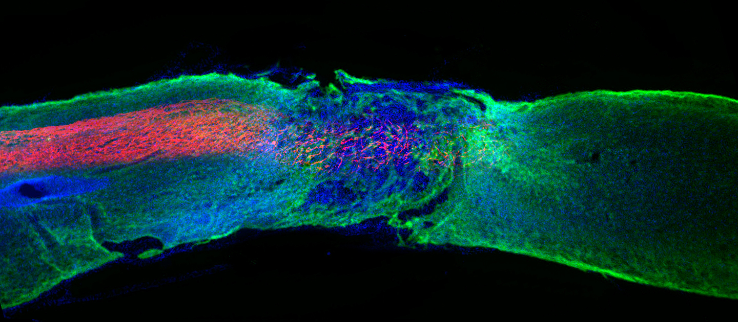 Northwestern researchers have developed a one-time, injectable therapy that sends signals to damaged and severed cells to encourage them to regenerate or proliferate. After a single injection, paralyzed animals with severe spinal cord injured regained the ability to walk within just four weeks.